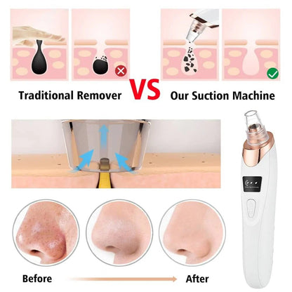 Blackhead Remover - Vacuum Pore Cleaner